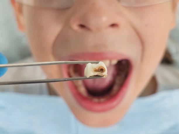 Best Emergency Treatment for Toothache in Callaway, FL